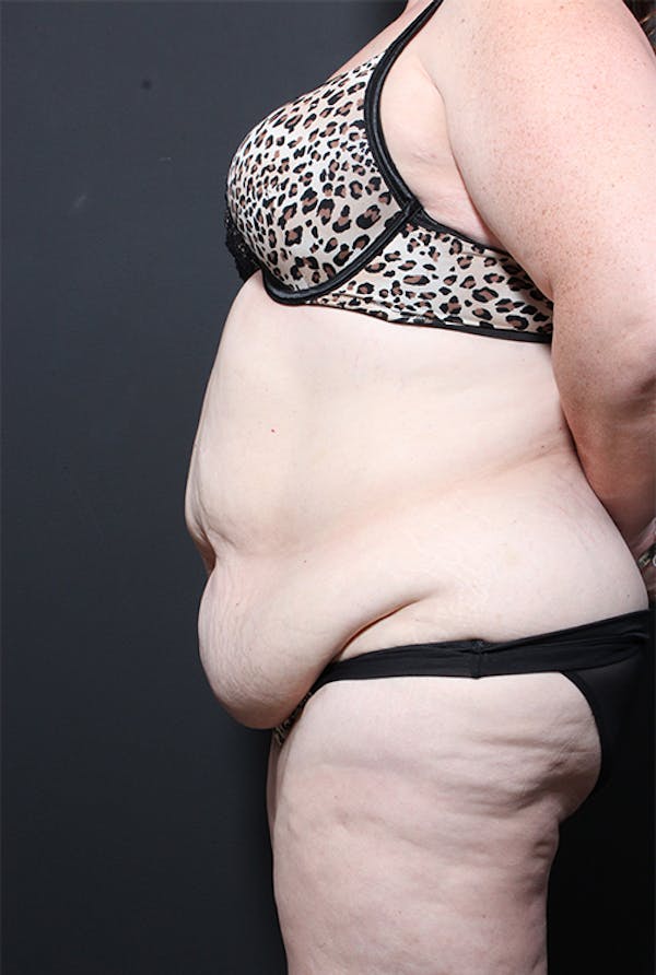 Plus Size Tummy Tuck® Before & After Gallery - Patient 14089702 - Image 5