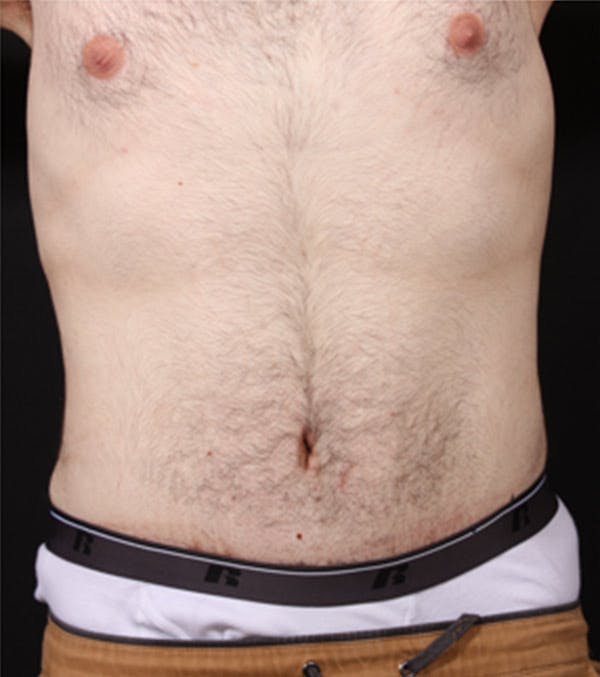 Male Tummy Tuck Before & After Gallery - Patient 14089711 - Image 4