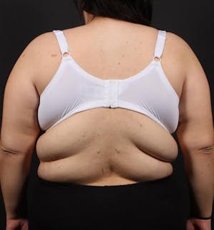 before and after bra line back lift results