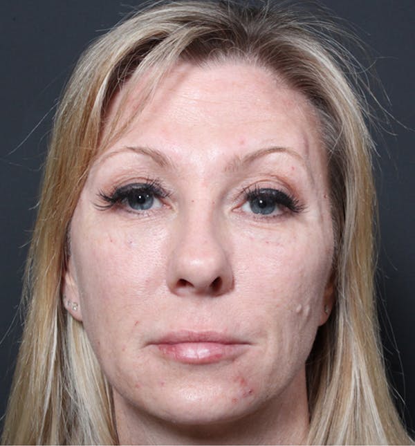 Injectables Before & After Gallery - Patient 14089714 - Image 4