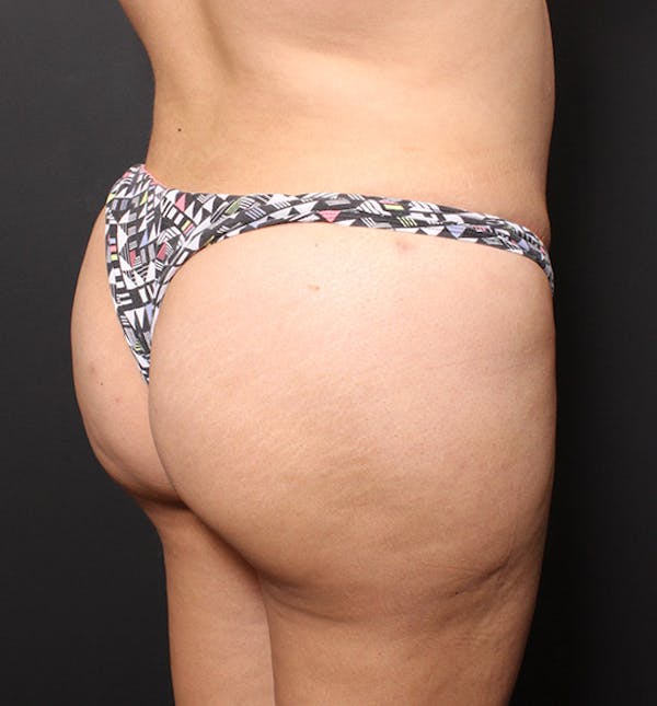 Brazilian Butt Lift Before & After Gallery - Patient 14089701 - Image 2