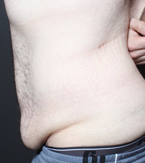 Male Tummy Tuck Before & After Gallery - Patient 14089711 - Image 5