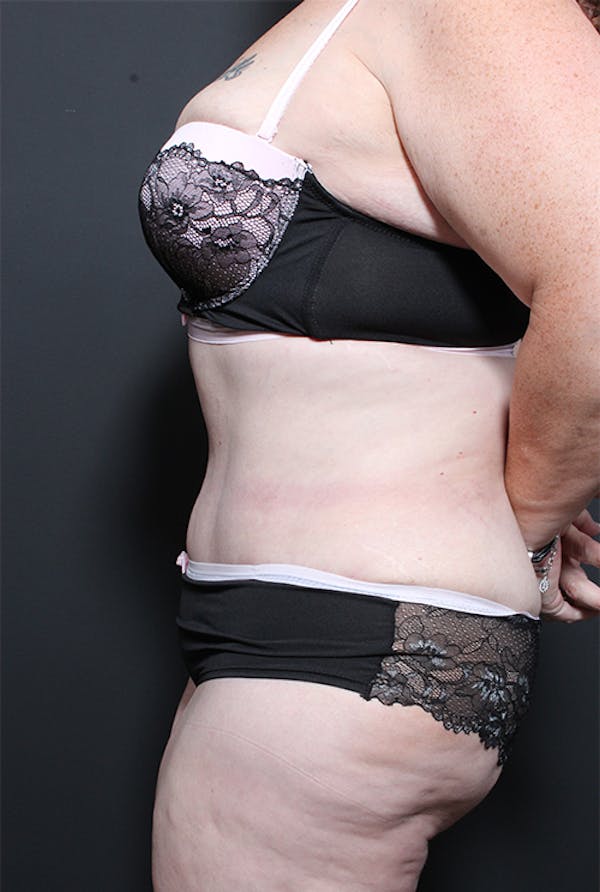 Plus Size Tummy Tuck® Before & After Gallery - Patient 14089702 - Image 6