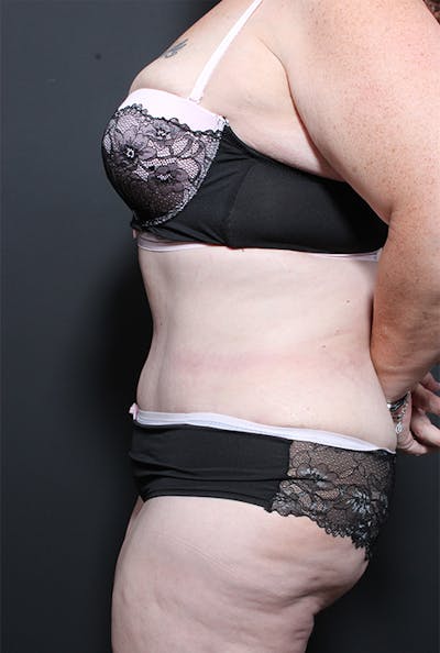 Plus Size Tummy Tuck® Before & After Gallery - Patient 14089702 - Image 6