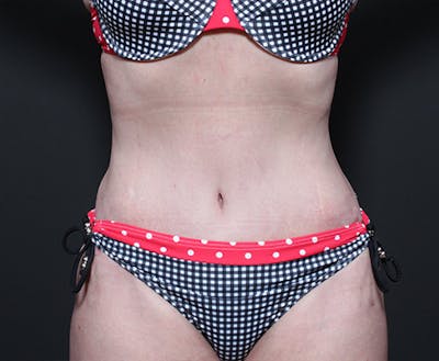 Tummy Tuck Before & After Gallery - Patient 14089705 - Image 4