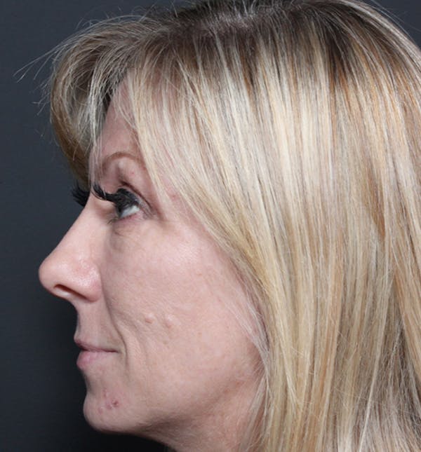 Injectables Before & After Gallery - Patient 14089714 - Image 5