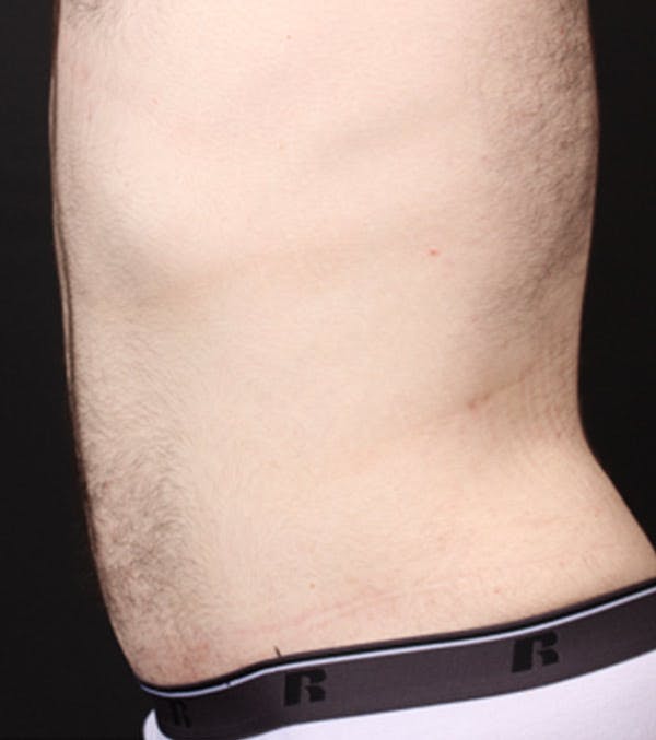 Male Tummy Tuck Before & After Gallery - Patient 14089711 - Image 6