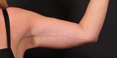 Arm Lift Before & After Gallery - Patient 14089710 - Image 4