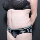 Mommy Makeover Gallery - Patient 14089718 - Image 2