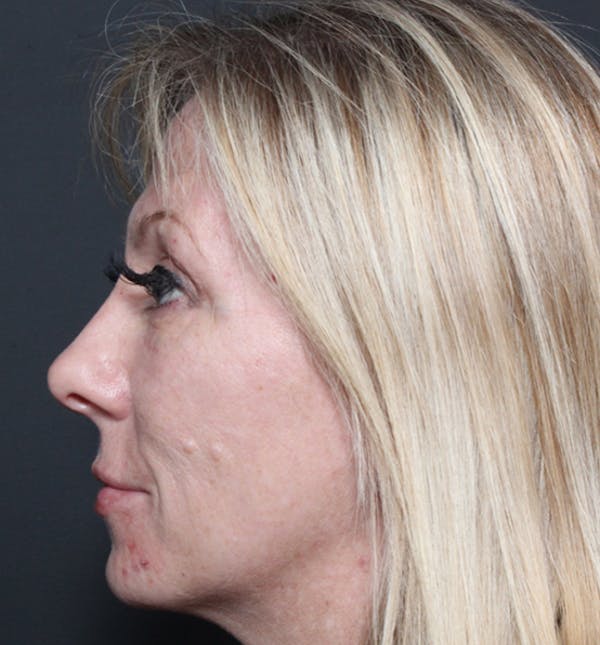 Injectables Before & After Gallery - Patient 14089714 - Image 6