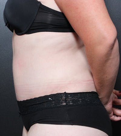 Liposuction Gallery - Patient 14089708 - Image 6