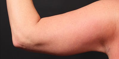 Arm Lift Before & After Gallery - Patient 14089710 - Image 6