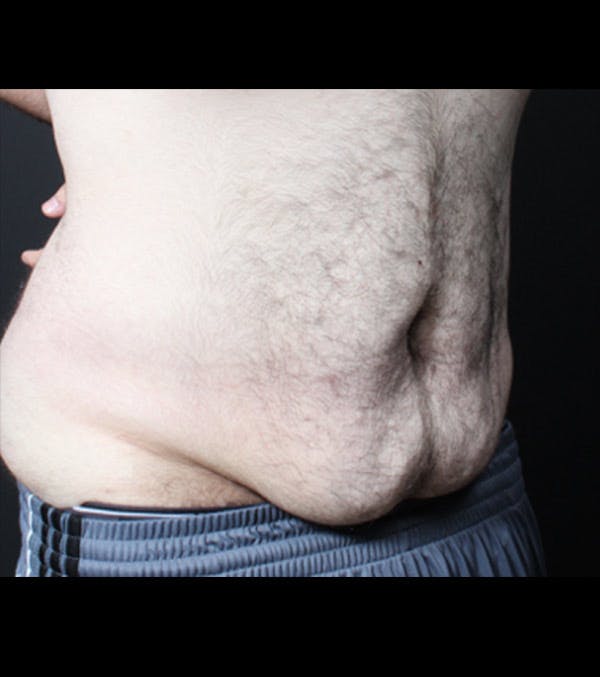 Male Tummy Tuck Before & After Gallery - Patient 14089711 - Image 9