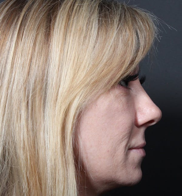 Injectables Before & After Gallery - Patient 14089714 - Image 7