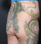 Brazilian Butt Lift Before & After Gallery - Patient 14089709 - Image 1