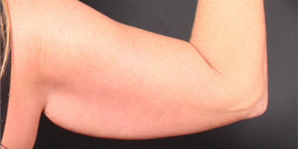 Arm Lift Before & After Gallery - Patient 14089710 - Image 7
