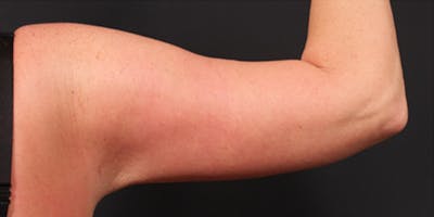 Arm Lift Before & After Gallery - Patient 14089710 - Image 8
