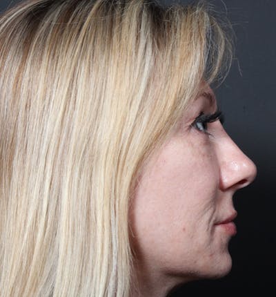 Injectables Before & After Gallery - Patient 14089714 - Image 8