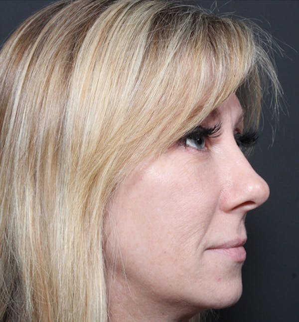 Injectables Before & After Gallery - Patient 14089714 - Image 9