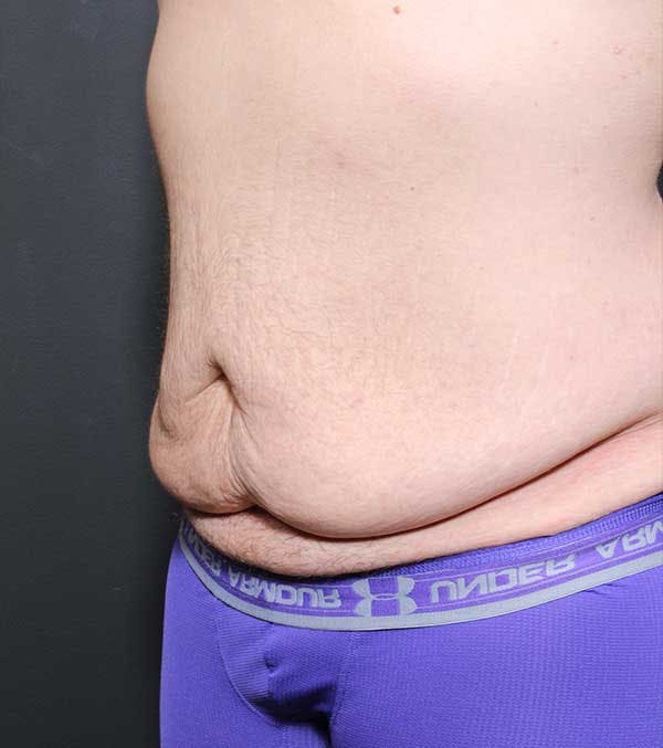 Male Tummy Tuck Before & After Gallery - Patient 14089732 - Image 1