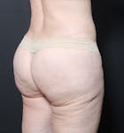 Brazilian Butt Lift Before & After Gallery - Patient 14089713 - Image 2