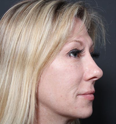 Injectables Before & After Gallery - Patient 14089714 - Image 10