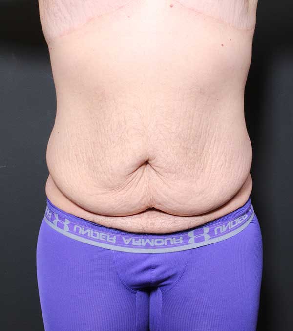 Male Tummy Tuck Before & After Gallery - Patient 14089732 - Image 3