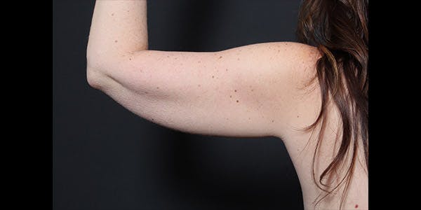 Arm Lift Before & After Gallery - Patient 14089715 - Image 3