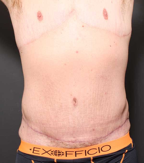 Male Tummy Tuck Before & After Gallery - Patient 14089732 - Image 4