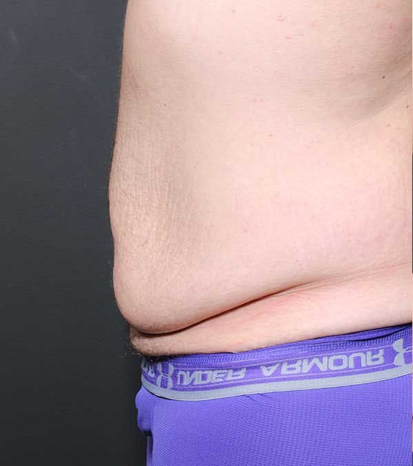 Male Tummy Tuck Before & After Gallery - Patient 14089732 - Image 5