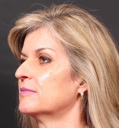 Injectables Before & After Gallery - Patient 14089736 - Image 1