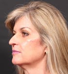 Injectables Before & After Gallery - Patient 14089736 - Image 2