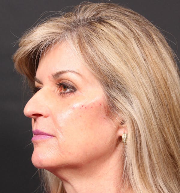 Injectables Before & After Gallery - Patient 14089736 - Image 2