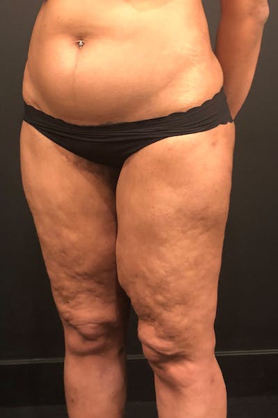 Thigh Lift Before & After Gallery - Patient 14089728 - Image 1