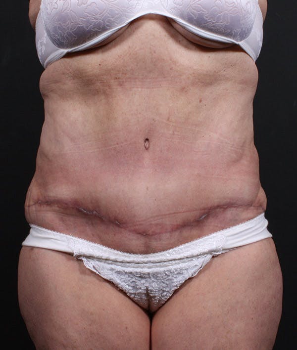Liposuction Before & After Gallery - Patient 14089724 - Image 4