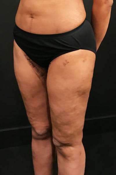 Thigh Lift Before & After Gallery - Patient 14089728 - Image 2
