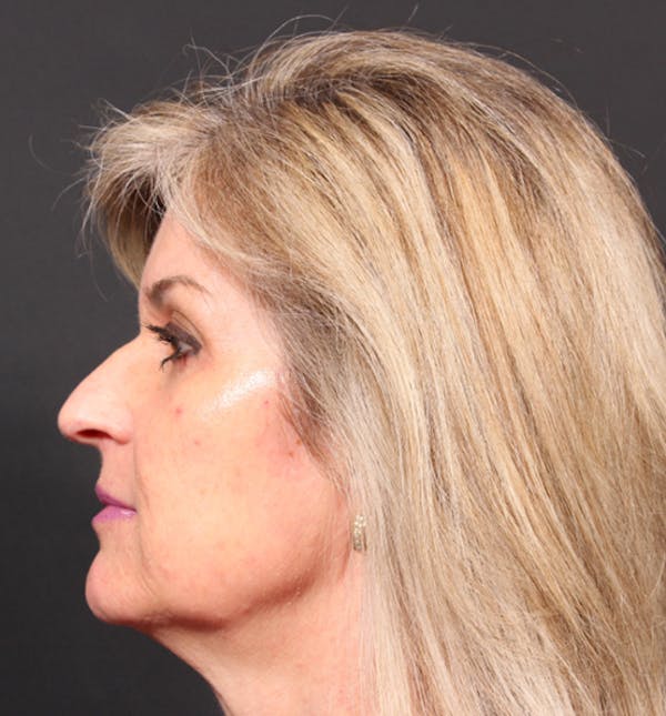 Injectables Before & After Gallery - Patient 14089736 - Image 5
