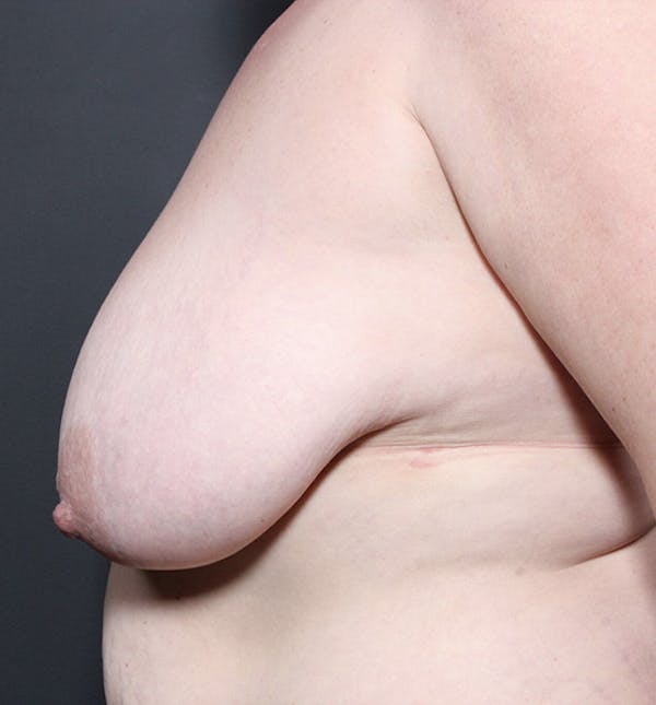 Breast Lift Mastopexy Before & After Gallery - Patient 14089725 - Image 5