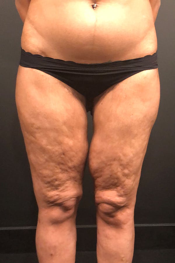 Thigh Lift Before & After Gallery - Patient 14089728 - Image 3