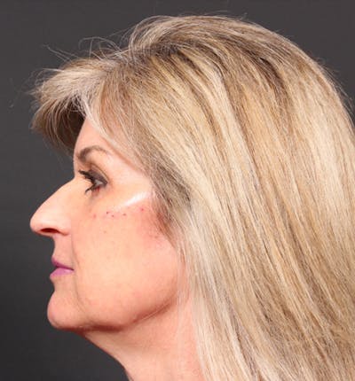 Injectables Before & After Gallery - Patient 14089736 - Image 6