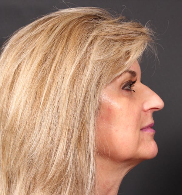 Injectables Before & After Gallery - Patient 14089736 - Image 7