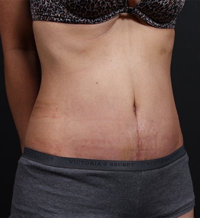 Hernia Rectus Diastasis Repair Before & After Gallery - Patient 14089733 - Image 2