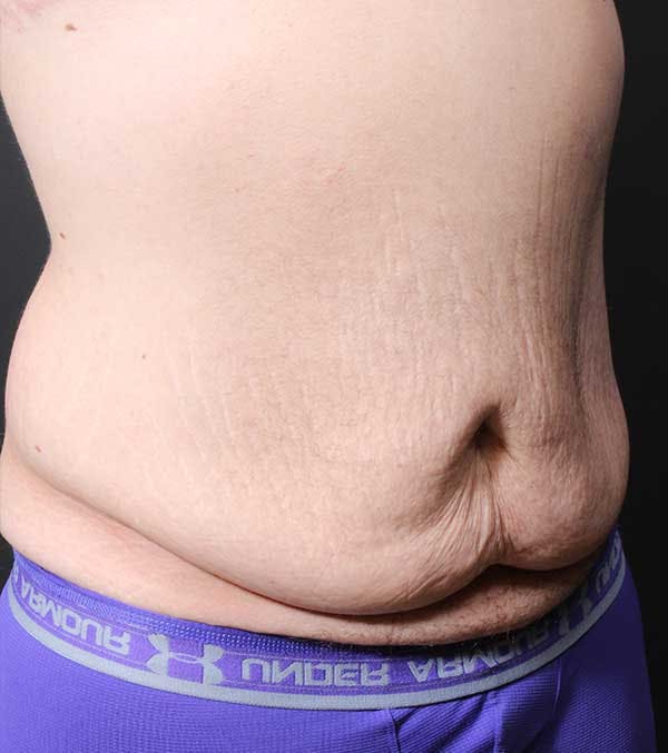 Male Tummy Tuck Before & After Gallery - Patient 14089732 - Image 7