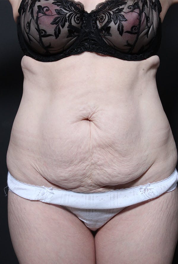 Liposuction Before & After Gallery - Patient 14089734 - Image 3