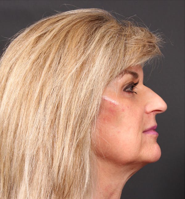 Injectables Before & After Gallery - Patient 14089736 - Image 8