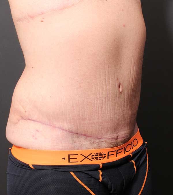 Male Tummy Tuck Before & After Gallery - Patient 14089732 - Image 8