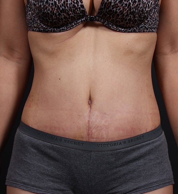 Hernia Rectus Diastasis Repair Before & After Gallery - Patient 14089733 - Image 4