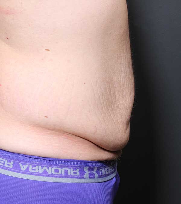Male Tummy Tuck Before & After Gallery - Patient 14089732 - Image 9