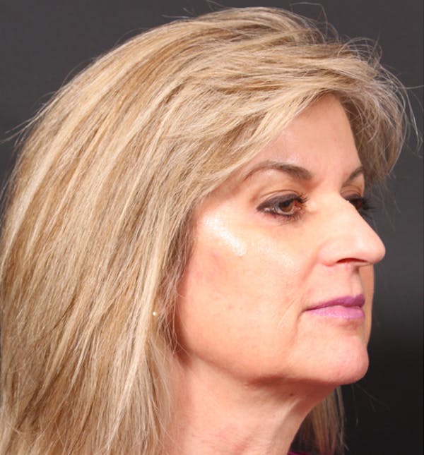 Injectables Before & After Gallery - Patient 14089736 - Image 9