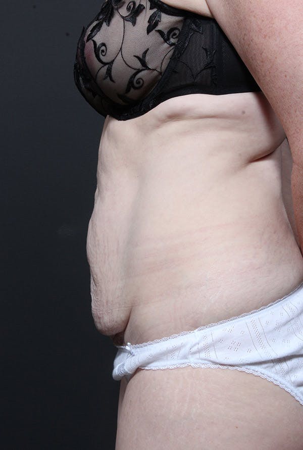 Liposuction Before & After Gallery - Patient 14089734 - Image 5